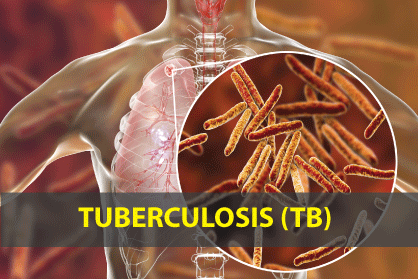 Full Form of TB